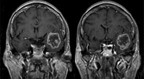 malignant-brain-tumor.jpg